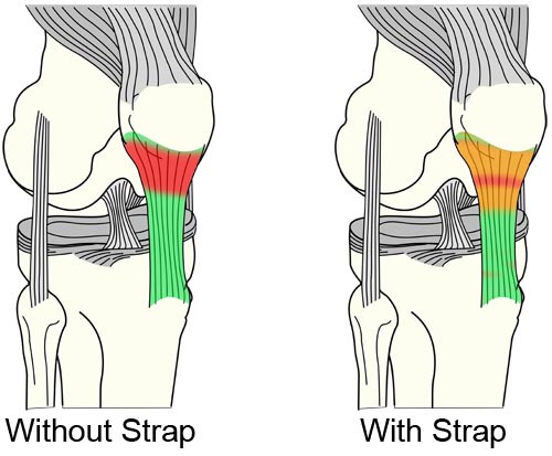 patellar tendon strap